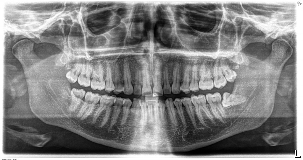 Wisdom Tooth Removal - Cornubia Dental,Loganholme Brisbane